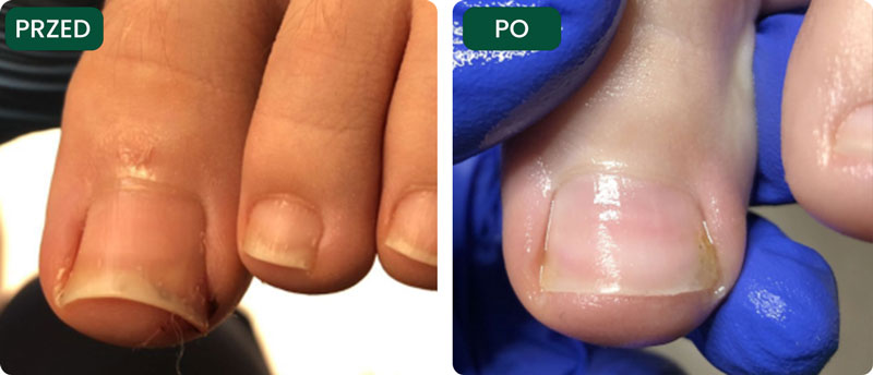 Terapia wrastających paznokci u 12 letniego chłopca.